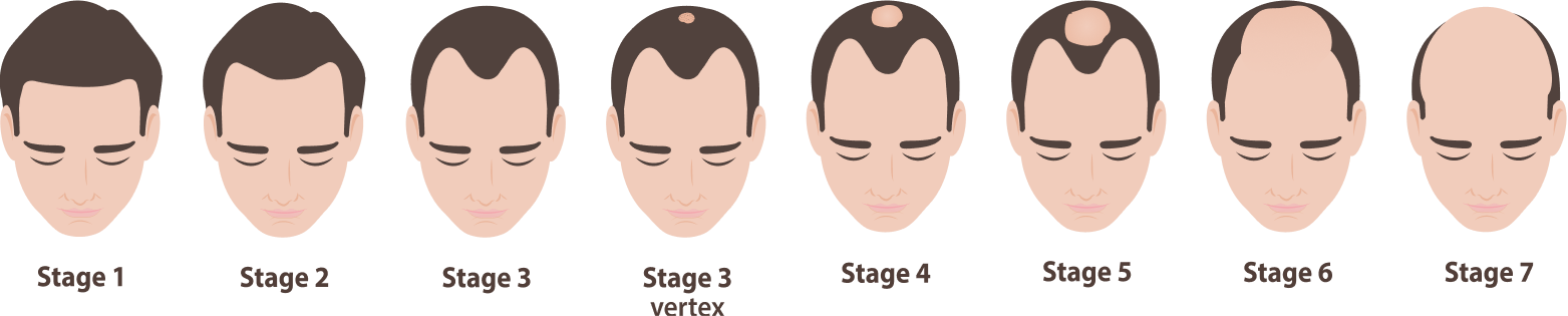 Stylized progression of the Norwood scale showing seven stages of male pattern hair loss from no visible loss at NW 1 to advanced horseshoe pattern at NW 7